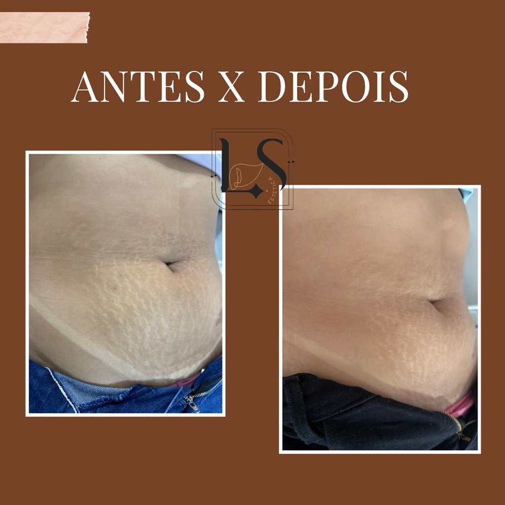 Resultado de tratamento facial